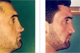 3 monthsths after Secondary Rhinoplasty