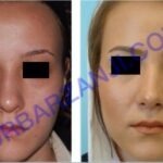 جراحی بینی، یک سال بعد از عمل