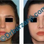 جراحی پلاستیک بینی نه ماه بعد از عمل