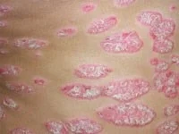 پسوریازیس خطر ابتلا به سکته مغزی و نامنظم شدن ضربان قلب را افزایش می دهد