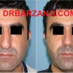 یک ماه بعد از جراحی بینی