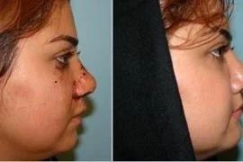 صدمات بینی