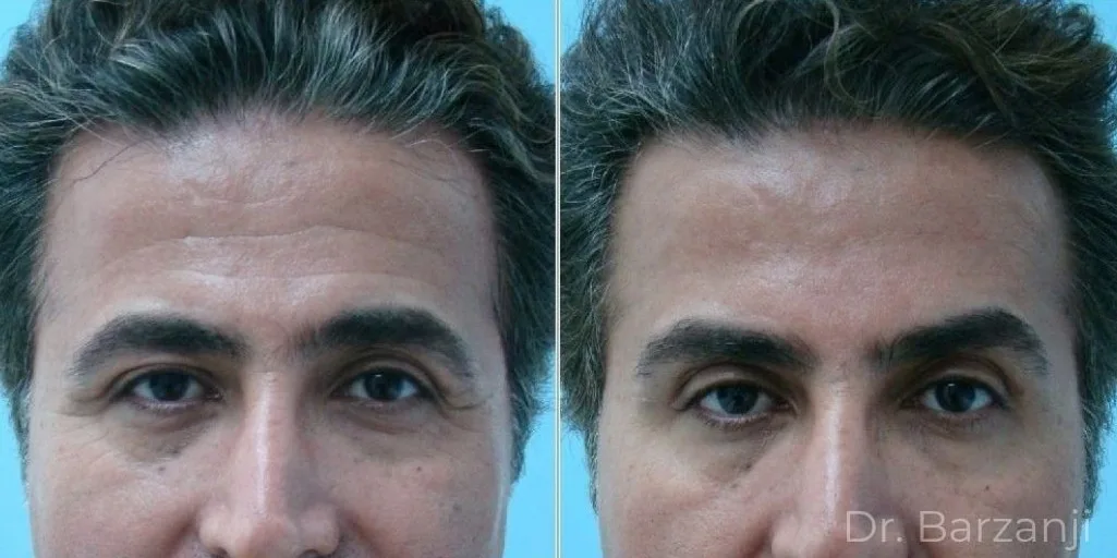 عکس قبل و بعد از تزریق بوتاکس در ناحیه چین و چروک پیشانی