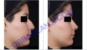 طراحی کامپیوتری قبل از جراحی پلاستیک بینی