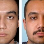 جراحی بینی، یک سال بعد از عمل