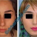 جراحی بینی و پروتز چانه چهار سال بعد از عمل