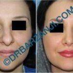 جراحی بینی یک سال بعد از عمل
