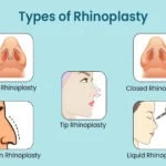 انواع رینوپلاستی