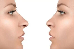 رینوپلاستی: انواع عمل بینی و مزایای هر کدام