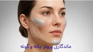 ماندگاری پروتز چانه و گونه و محل قرارگیری پروتزها در ساختار صورت
