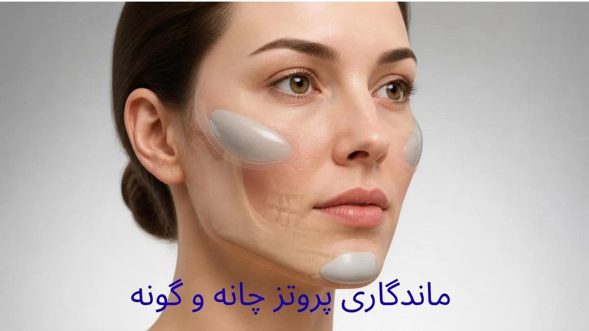 ماندگاری پروتز چانه و گونه و محل قرارگیری پروتزها در ساختار صورت