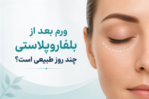ورم بعد از بلفاروپلاستی چند روز طبیعی است؟