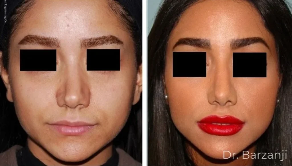 عکس قبل و بعد از جراحی ترمیمی (ثانویه) بینی با پیوند غضروف گوش- نمای روبرو