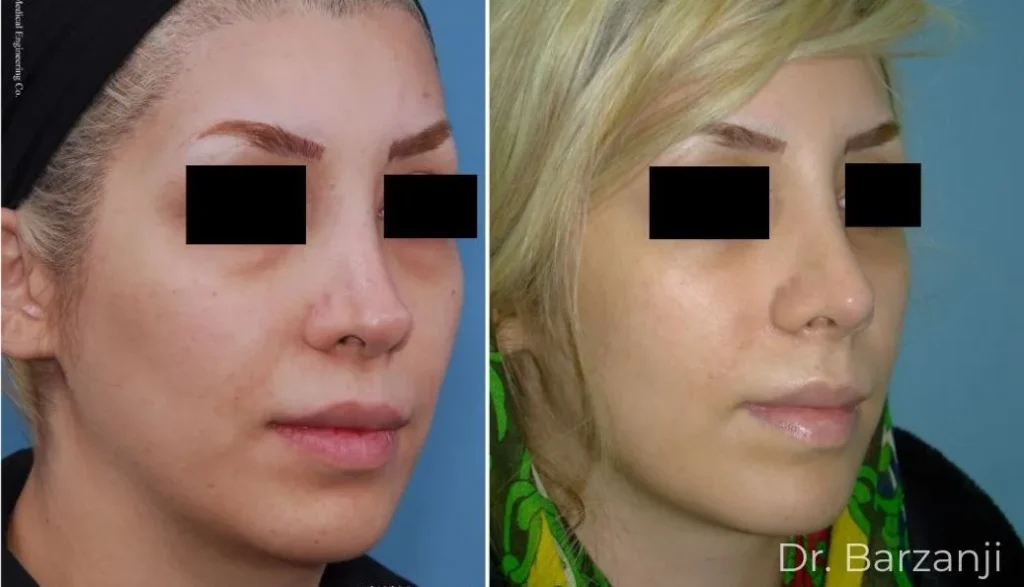 عکس قبل و بعد از جراحی بینی ثانویه (ترمیمی) نمای روبرو