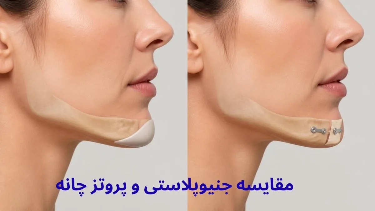 مقایسه پروتز چانه و جنیوپلاستی اسلایدینگ برای اصلاح برجستگی و فرم چانه