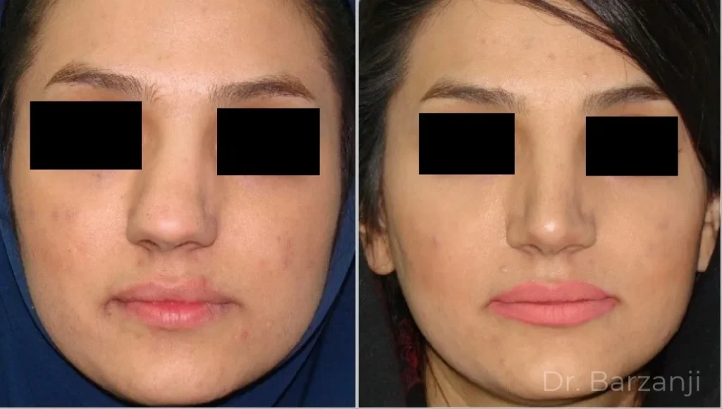 عکس قبل و بعد از جراحی بینی کج خانم