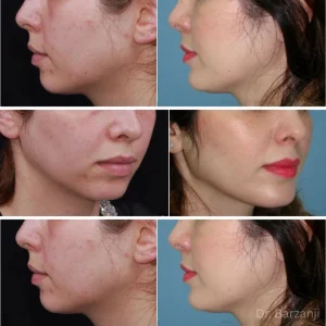 عکس قبل و بعد از جراحی پروتز چانه- خانم- نمای نیمرخ دو طرف و سه چهارم راست