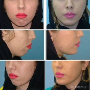 عکس قبل و بعذ از عمل پروتز چانه خانم نمای روبرو- نیمرخ- سه چهارم