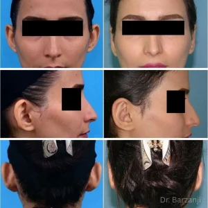 تصاویر قبل و بعد از جراحی گوش (اتوپلاستی)