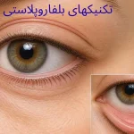 تکنیک بلفاروپلاستی-تصویر چشم و نشان دادن محل برش جراحی پلک