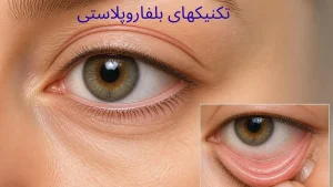 تکنیک بلفاروپلاستی-تصویر چشم و نشان دادن محل برش جراحی پلک