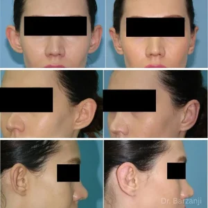 عکس قبل و بعد از جراحی گوش (اتوپلاستی) خانم نمای رویرو نیمرخ سه چهارم