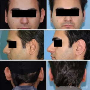 عکس قبل و بعد از جراحی گوش (اتوپلاستی) آقا- نمای روبرو- نیمرخ- پشت سر