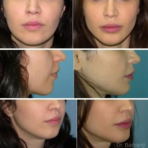 عکس قبل و بعد از جراحی پروتز چانه- خانم- نمای روبرو- نیمرخ- سه چهارم